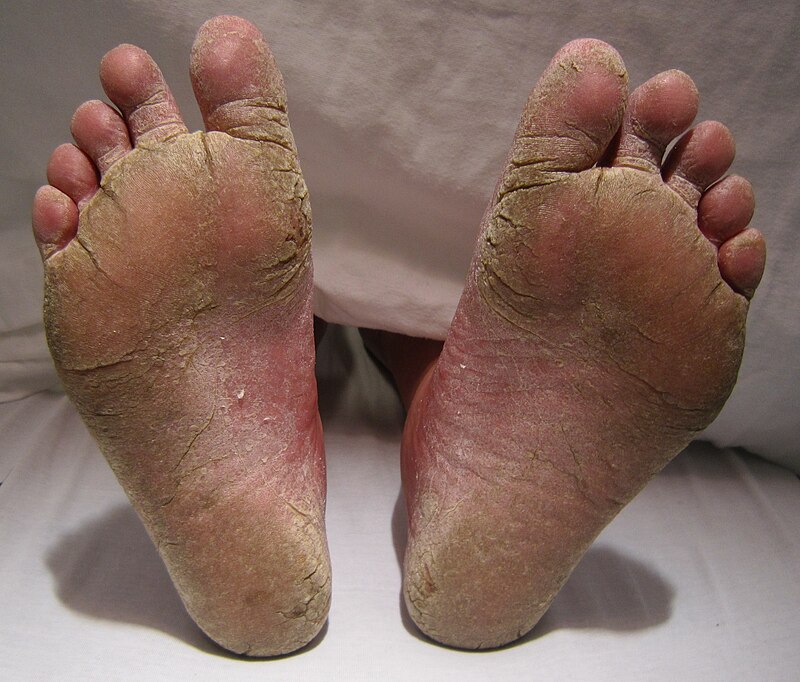 800px-FeetFungal.JPG